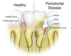 Chart comparing a healthy tooth and one infected with gingivitis