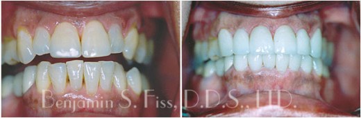 Before & After Porcelain Veneers | Dr. Benjamin Fiss | Chicago