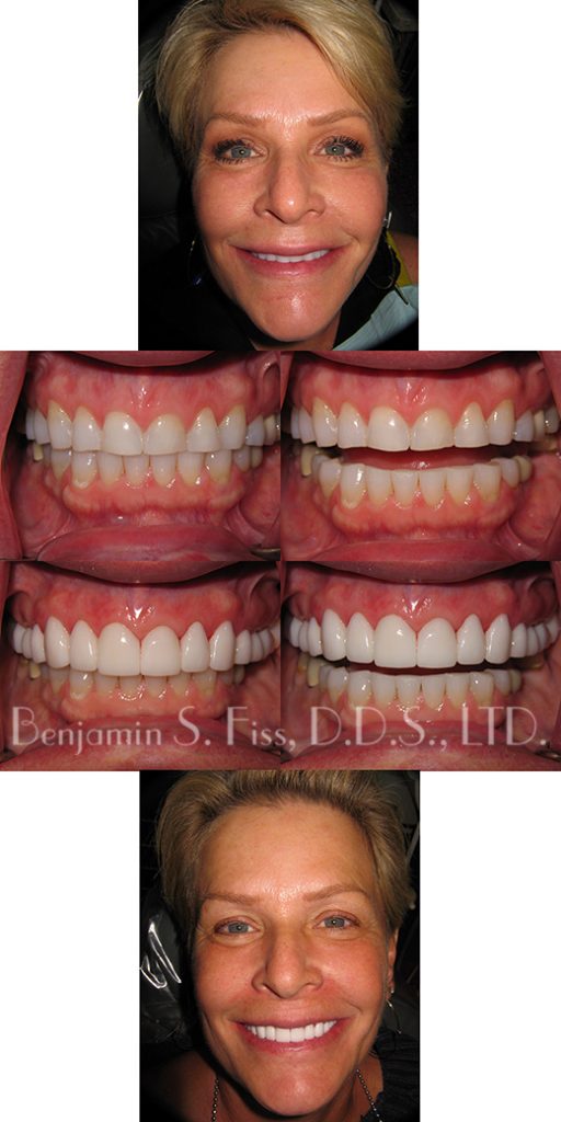 Porcelain Veneers in Chicago, IL Chicago Benjamin S. Fiss, D.D.S.