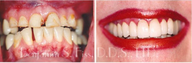 Cosmetic Dentistry Before and After Photos