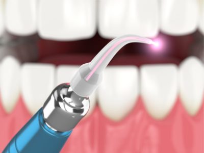 3D image of dental diode laser used to treat gums