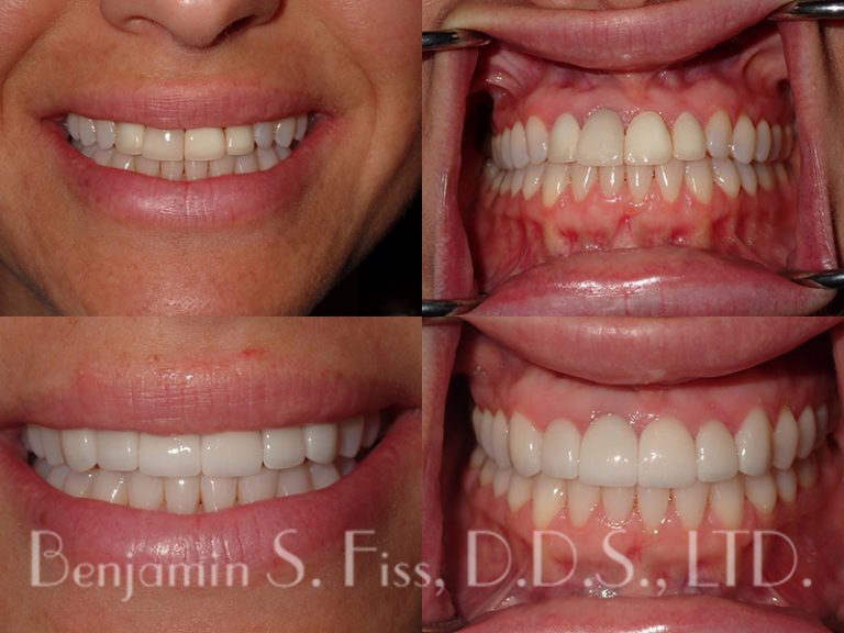 Porcelain Veneers in Chicago, IL Chicago Benjamin S. Fiss, D.D.S.