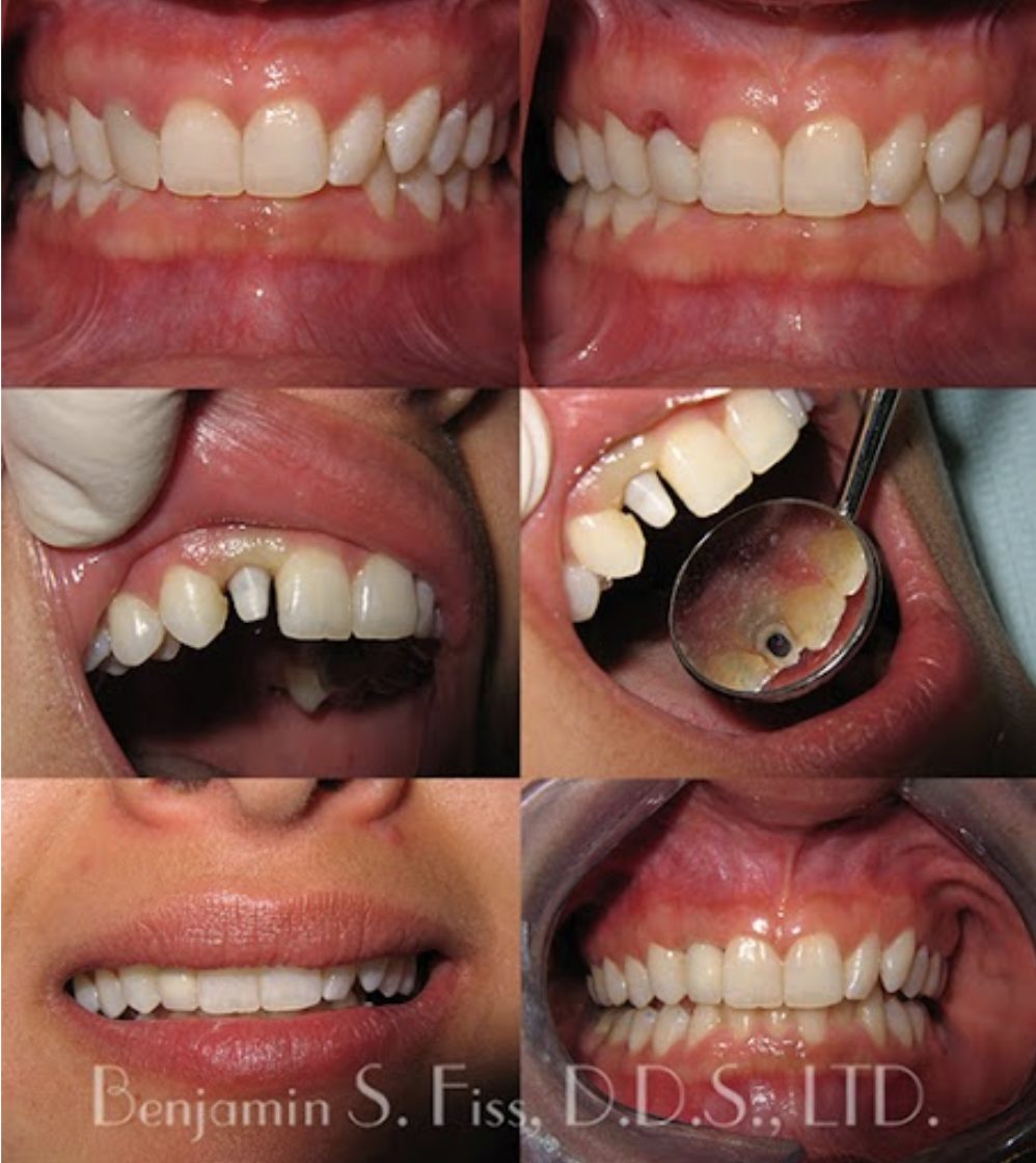 Before and after images showing the results of a dental implant placed in Chicago, IL.