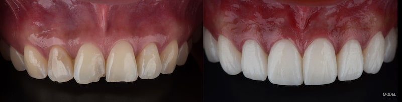 Porcelain veneers, before and after picture.