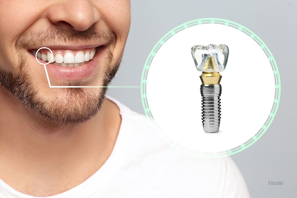 The lower face of a man and insert of dental implant illustrating where an implant was placed.